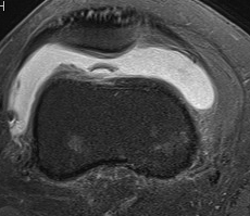 Loose Body Knee MRI PFJ